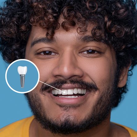 How Long Do Dental Implants Last?