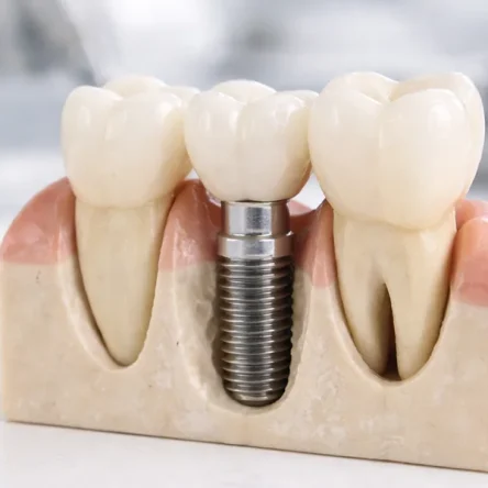 5 Signs You May Benefit From a Dental Implant